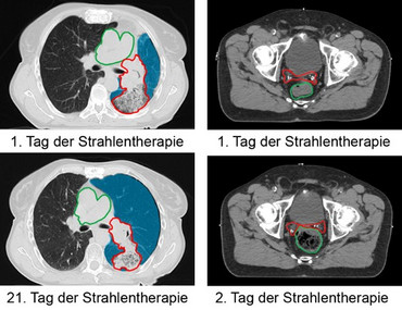 Presseinformation 163 zum Thema "Highend-Gerät für die präzise Therapie von Krebspatient*innen"